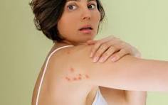 bed bug bites